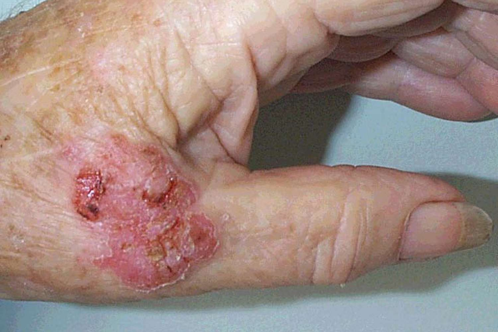 Bowen's disease